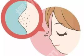 牙膏去黑头有用吗?科普知识介绍!一看便知!