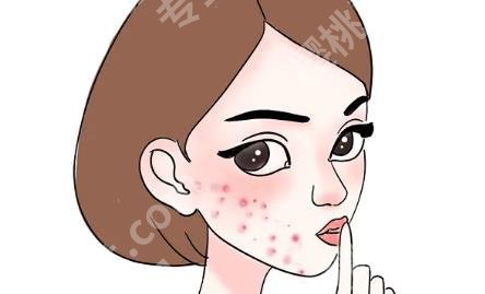 脸上长痘痘怎么去除?3种方法介绍!一看便知!