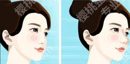 北京薛志强人中缩短技术如何?医院口碑公开!价格预览!