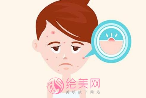 露得清清滢祛痘凝露祛痘的果好不好?有真人使用案例哦!