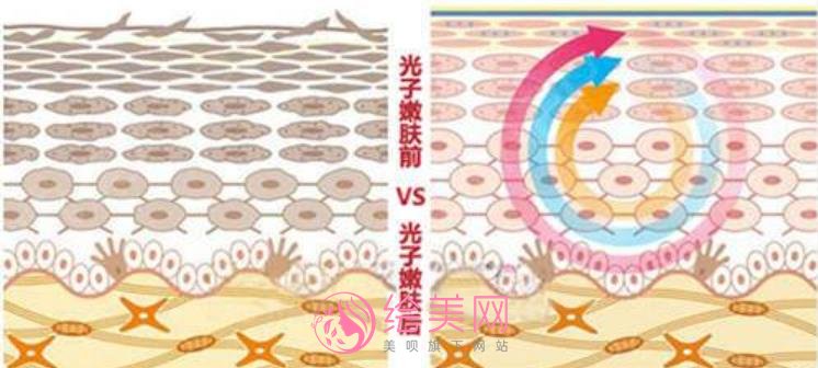 光子嫩肤对皮肤有伤害吗?做嫩肤项目前后有哪些需要注意的?