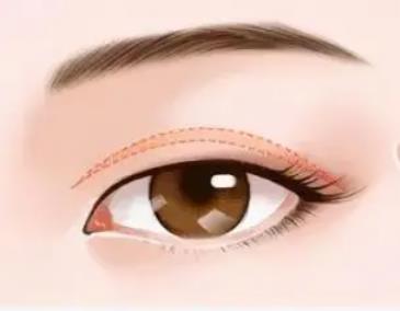 上睑下垂恢复期是多久？做眼部整形术前术后需要注意哪些事情？