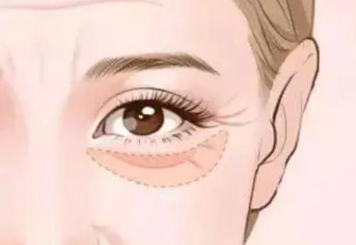眼袋切除一般需要多少天能恢复？做手术后需要注意哪些事情？