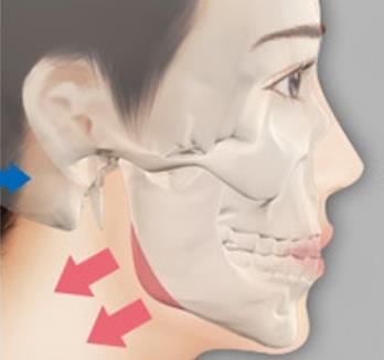 下颌角整形手术原理是什么？类型有几种？注意事项分享！