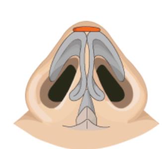 耳软骨垫鼻尖吸收率如何？做鼻尖整形之后如何护理？注意事项分享！