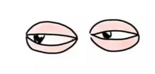 眼睑吸脂前后对比差别大吗？来看看真人做眼部整形案例图吧！