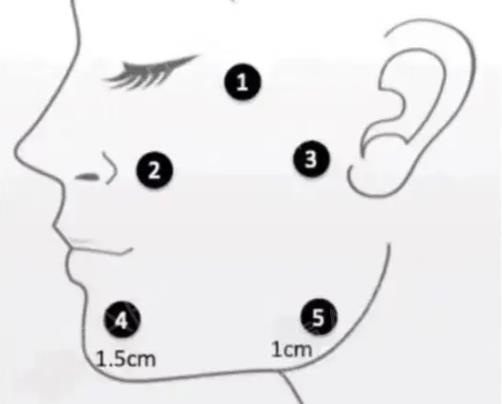 面部轮廓提升针是什么原因？注射之后有果吗？