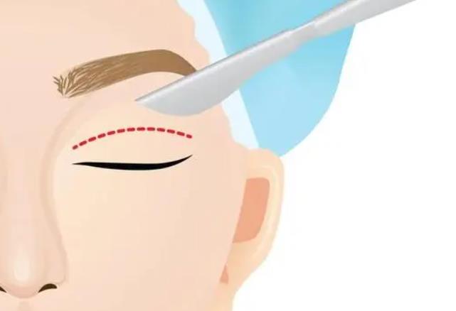 全切双眼皮恢复过程图曝光！手术后对比照分享！