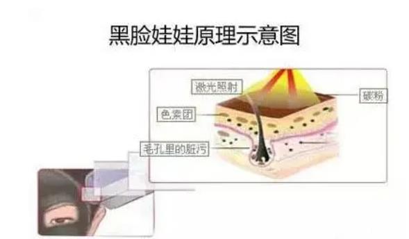 做黑脸娃娃的副作用有哪些?原理是什么?术后要注意哪些?