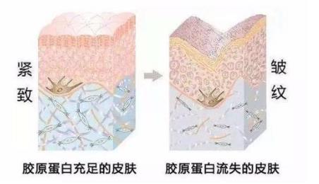 注射胶原蛋白的作用是什么?做完注射之后需要注意哪些事情?