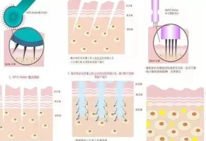 注射胶原蛋白的作用是什么?做完注射之后需要注意哪些事情?
