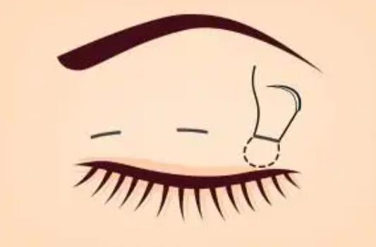 美杜莎双眼皮是怎么样的?来看看真人做眼部整形对比图吧