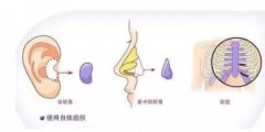 韩式三段隆鼻实操过程来袭！来看看真人做鼻部整形对比图吧