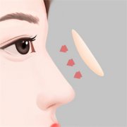 隆鼻假体取出耳软骨恢复期注意事项有哪些？下面有详细分享！
