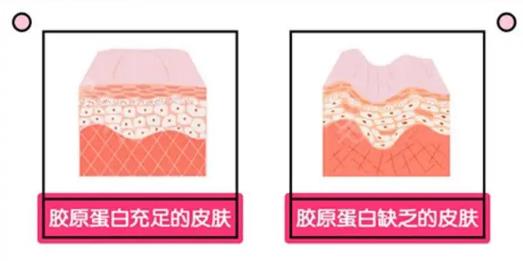 注射胶原蛋白的作用有哪些?原理get!注意事项有哪些?