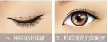韩式三点式双眼皮能维持多久?操作原理是什么?注意事项有哪些?