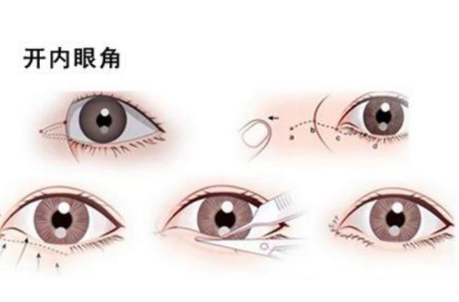 刘恒鑫做双眼皮好吗?刘医生实操眼部整形案例分享!