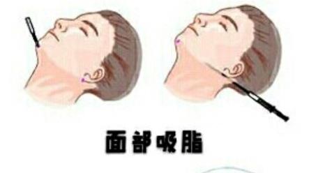 上海九院整形价格贵吗?医院口碑好吗?面部吸脂前后对比图曝光!