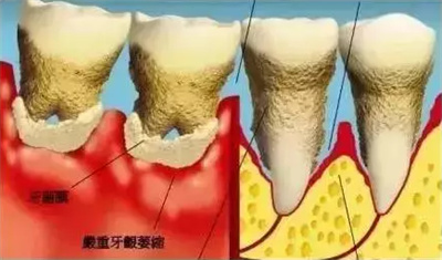 牙龈萎缩的调节方法有哪些?怎样可以恢复受损牙龈?