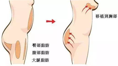 自体脂肪移植丰胸手术好吗?优势以及缺点来公布!