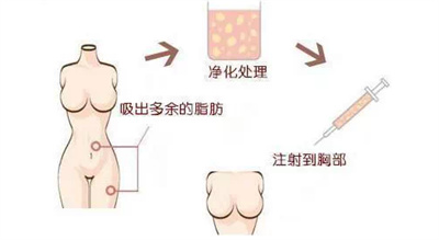 自体脂肪移植丰胸手术好吗?优势以及缺点来公布!