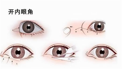 开眼角会留疤痕吗?防止留疤痕需注意哪些问题?