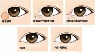 开眼角会留疤痕吗?防止留疤痕需注意哪些问题?
