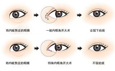 开眼角后遗症有哪些？普及几种开眼角类型？