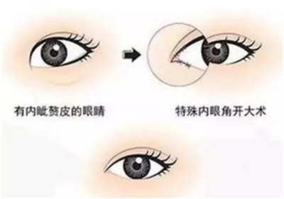开眼角眼睛会变大吗?美眼的秘诀
