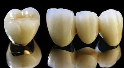 钛合金烤瓷牙的寿命是多少?怎样正确使用呢?