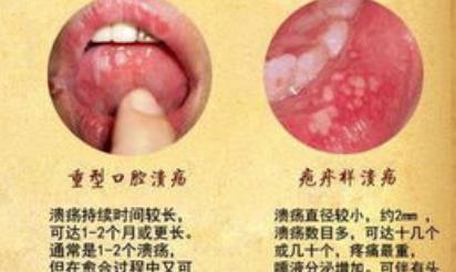 如何调节口腔溃疡,有效调节口腔溃疡方法提供