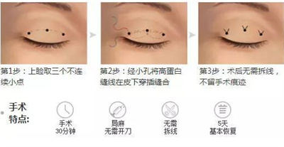 埋线双眼皮维持多久?哪种人群更为适用?