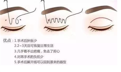 埋线双眼皮维持多久?哪种人群更为适用?