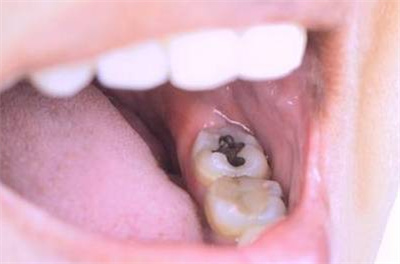 虫牙是真的有虫吗?何种原因引起?