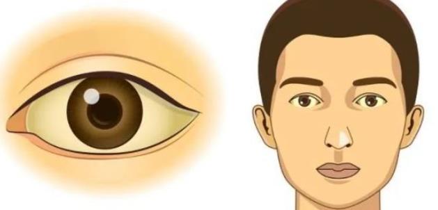武汉同济黄立双眼皮修复的技术好不好?来看看修复后的真人照片吧!