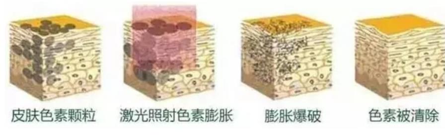 徐增亮医生怎么样?真人做斑点去除过程图来袭!价格参考