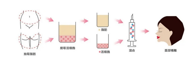 自体脂肪丰苹果肌如何?真实案例全过程,打造精致芭比脸!
