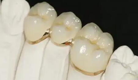 烤瓷牙多少钱一颗?费用贵不贵?快来瞅瞅