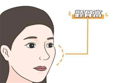 黄大勇颧骨内推,医生详细介绍,颧骨内推案例分享!