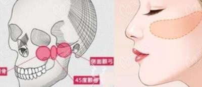 黄大勇颧骨内推,医生详细介绍,颧骨内推案例分享!