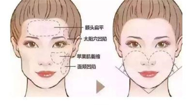 黄大勇颧骨内推,医生详细介绍,颧骨内推案例分享!