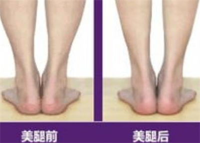 小腿吸脂安全吗?吸脂后影响走路吗?