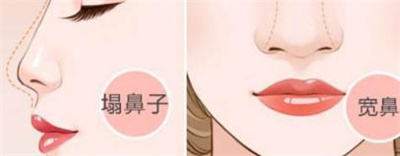 隆鼻手术风险有多大,隆鼻手术需要多长时间恢复?