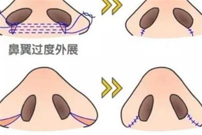 隆鼻手术风险有多大,隆鼻手术需要多长时间恢复?
