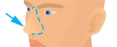 成都素美卢元刚怎么样?隆鼻案例分享,新价格表更新!