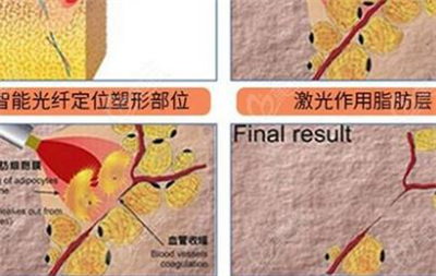 激光溶脂瘦脸的危害有哪些?瘦脸整形多少钱?