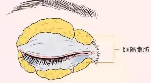 上睑皮肤松弛矫正的方法有哪些?双眼皮和切眉那种效果好?术后护理方式有哪些?