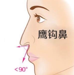 怎样改良鹰钩鼻子?做矫正术手术有没有用?手术前后注意事项分享