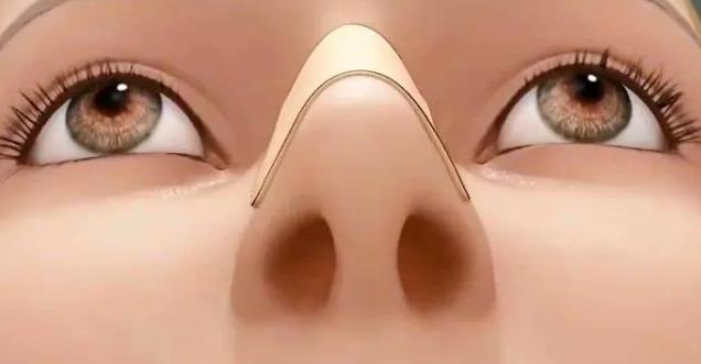 固体硅胶隆鼻好吗?硅胶隆鼻优势特点是什么?科普篇