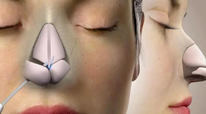 固体硅胶隆鼻好吗?硅胶隆鼻优势特点是什么?科普篇